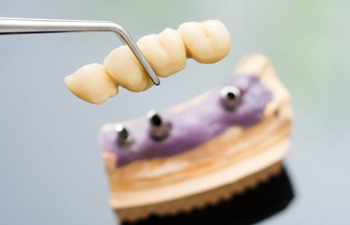 Dental Bridge for Long-Term Durability